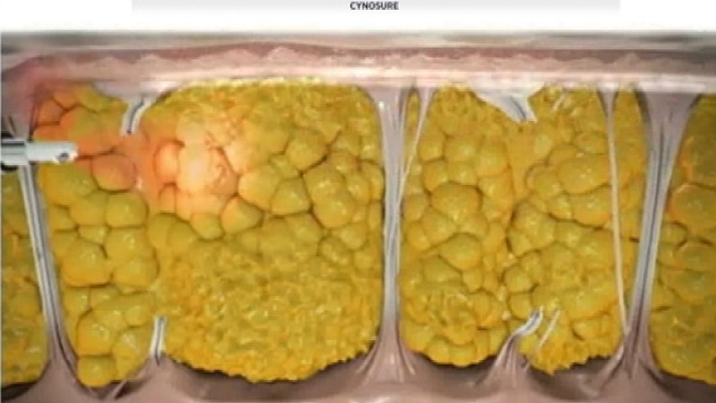 Finalmente, el láser calienta la piel para permitir el crecimiento de nuevo colágeno, lo que, según la compañía creadora de “Cellulaze”, aumenta la elasticidad.
