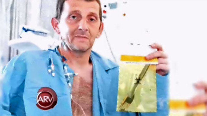 Este hombre se tragó accidentalmente un tenedor y fue su compañero durante una década. Mira la historia en video aquí