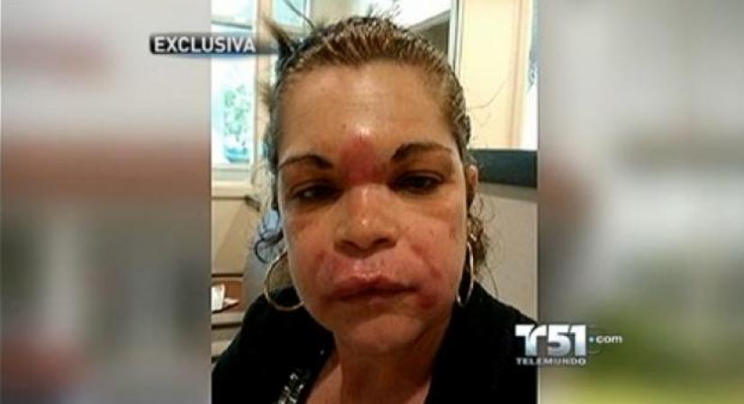 28 DE SEPTIEMBRE, 2012.- Isabel González asegura que recibió unas vitaminas que le costaron 890 dólares en el negocio Viviana’s Body Secret , que se encuentra en el Doral, que le dejaron el rostro hinchado y adolorido. <br /> Mira aquí las imágenes y lee los detalles de esta noticia..<br />