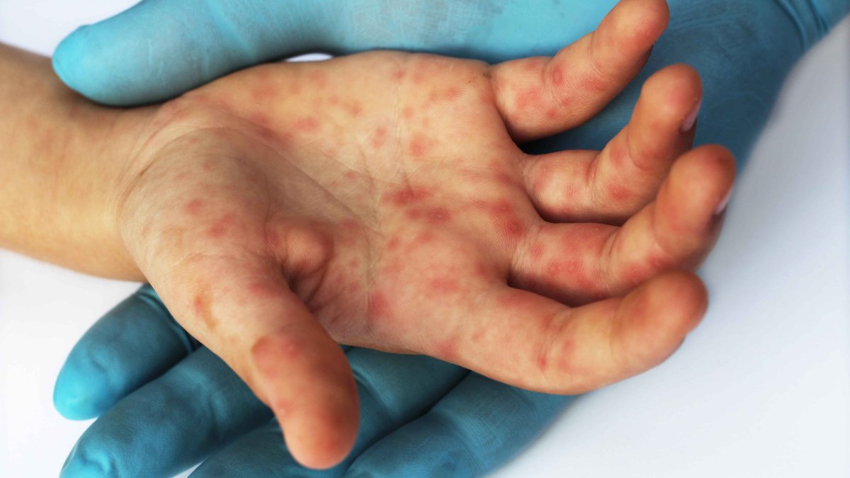 Measles Cases Rising in Texas - Telemundo Houston - News Directory 3