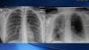 Vacunados vs. no vacunados: así lucen los pulmones de pacientes con COVID-19