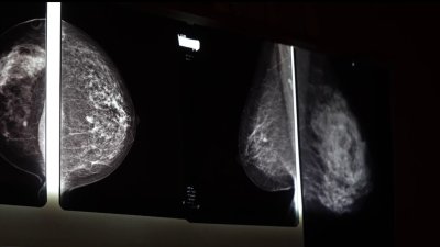 Exámenes de detención del cáncer de mama a bajo costo en Houston
