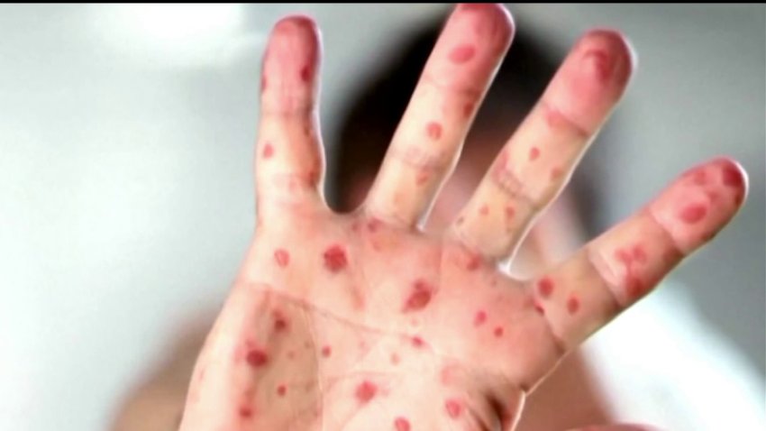 Aumentan casos de sarampión en Texas