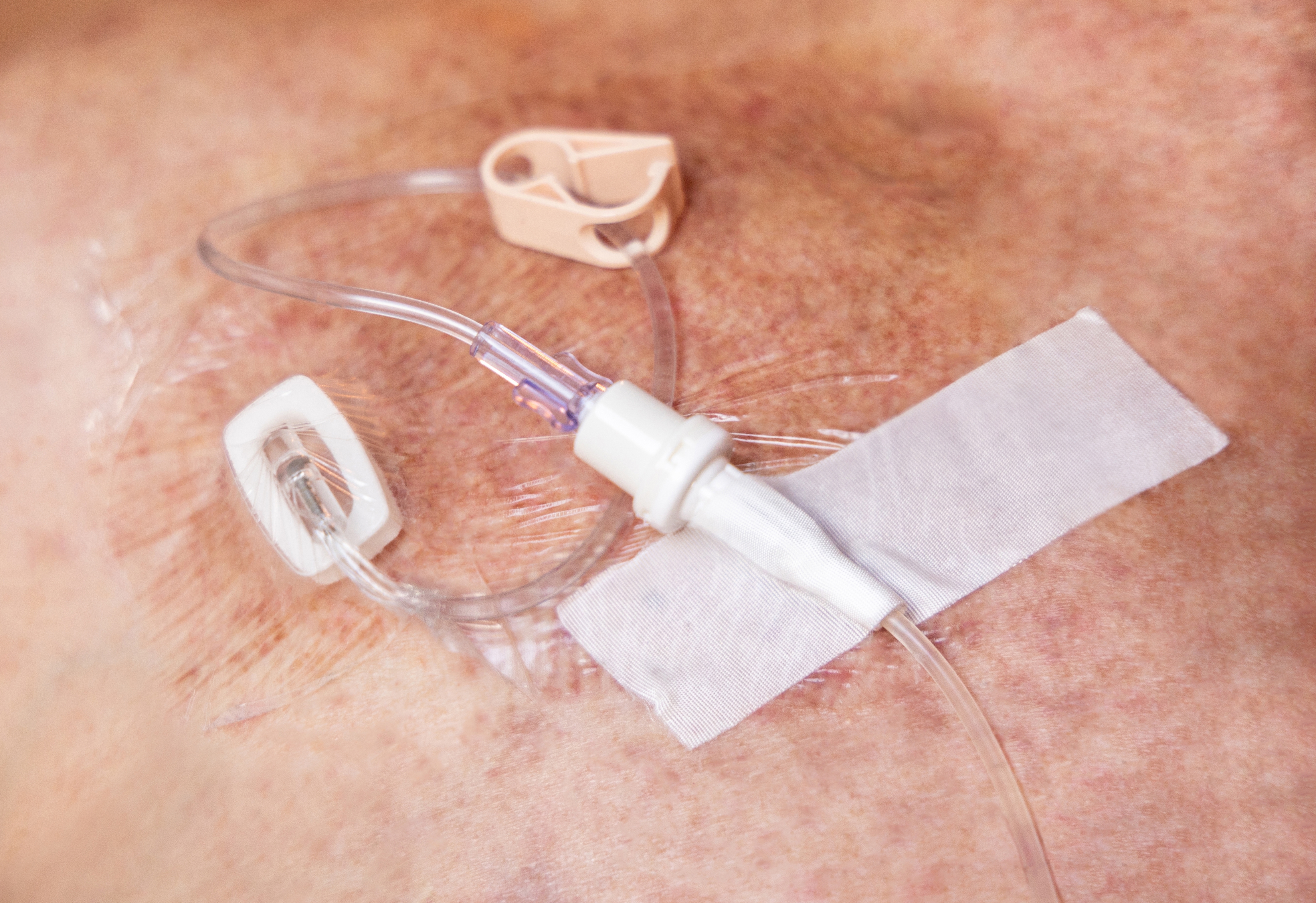 Nuevo logro en la lucha contra el cáncer: 7 de cada 10 pacientes sobreviven más de cinco años